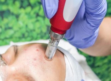 RF Micro-Needling RF Micro-Needling